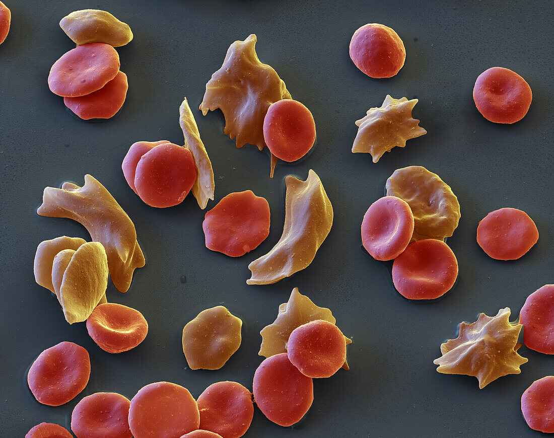 Sickle cell anaemia, SEM