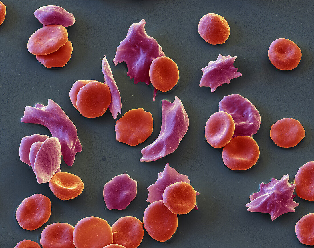 Sickle cell anaemia, SEM