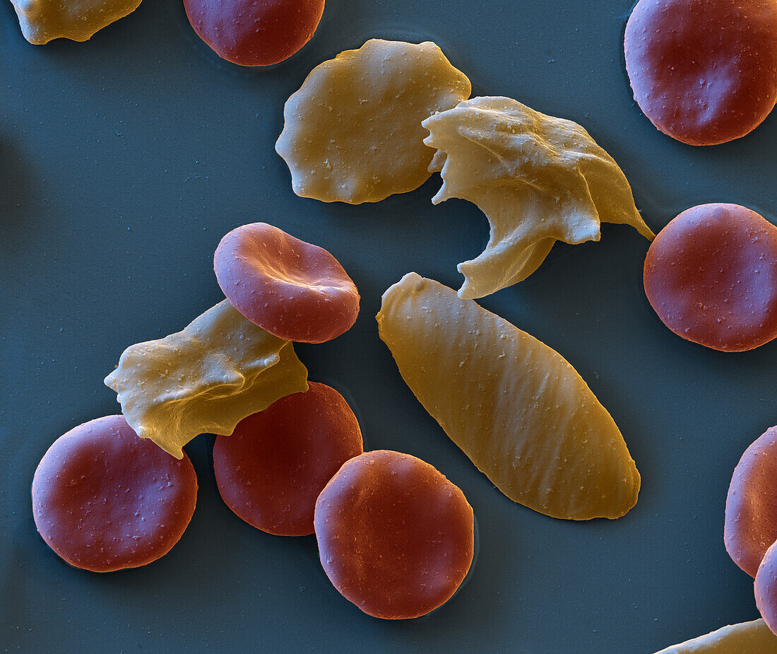 Sickle cell anaemia, SEM