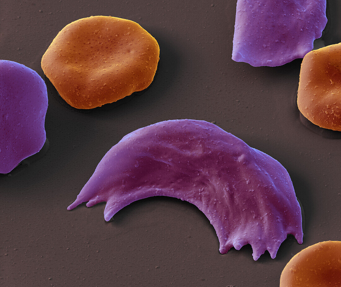 Sickle cell anaemia, SEM