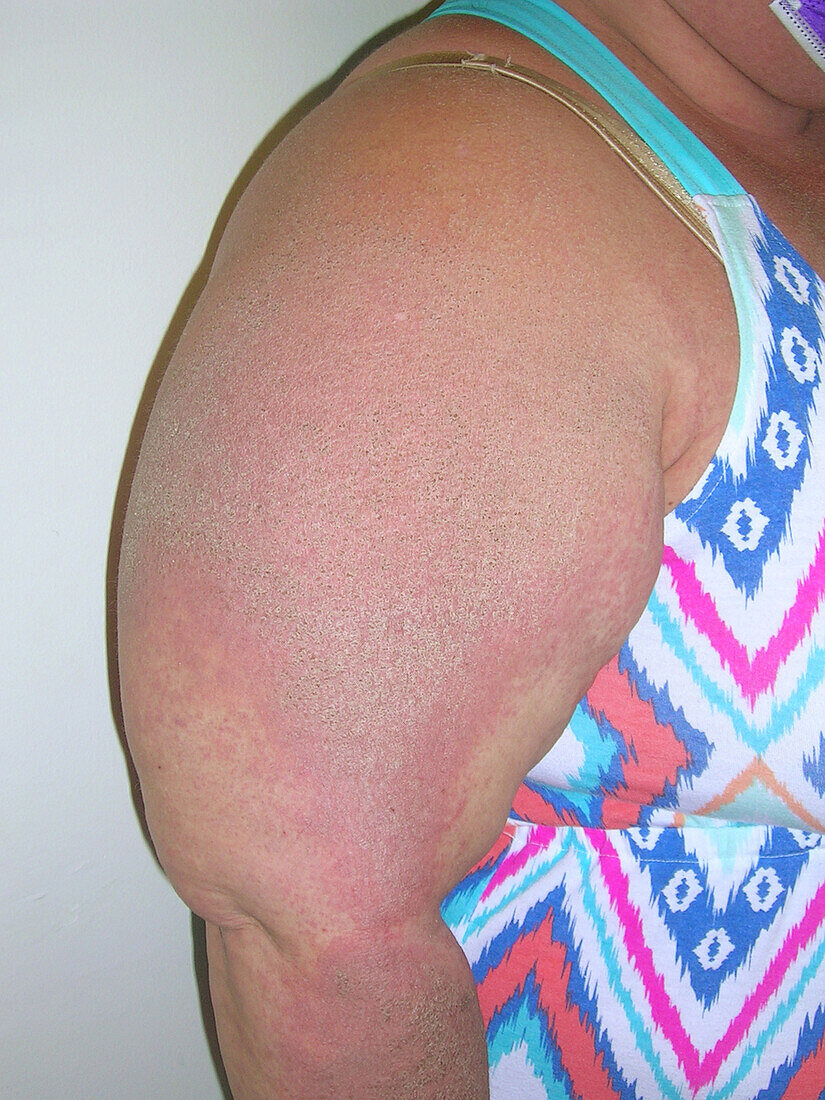 Lupus erythematosus