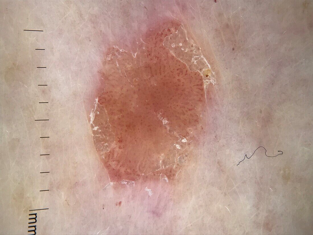 Seborrheic keratosis, dermoscopy