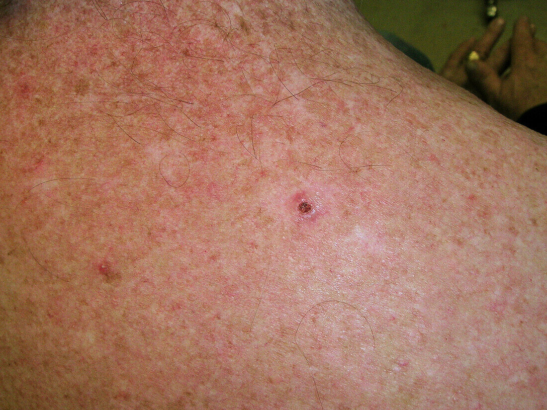 Basal cell carcinoma