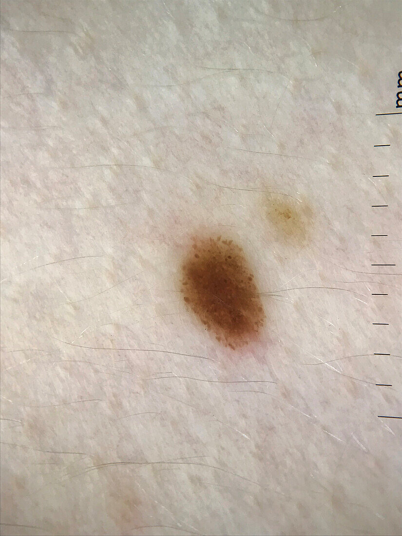 Peripheral globules in mole, dermoscopy