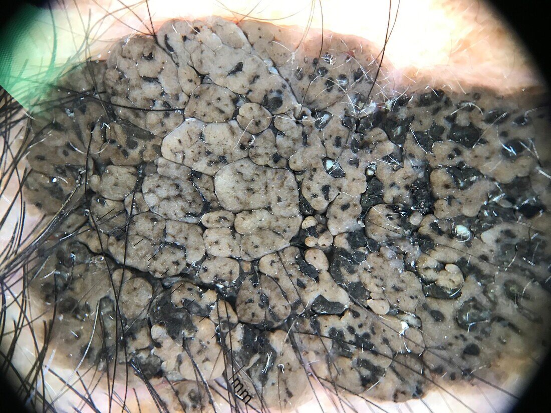 Seborrheic keratosis, dermoscopy