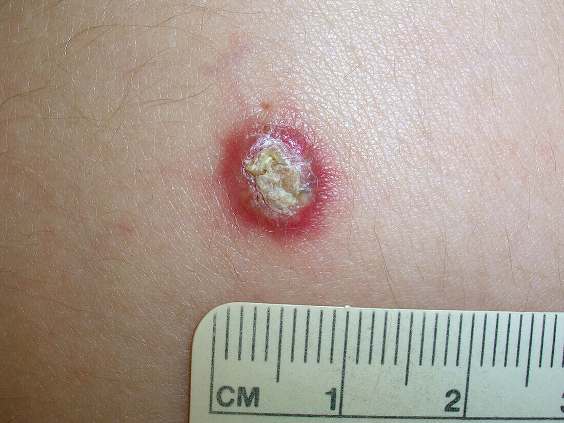 Pilomatricoma