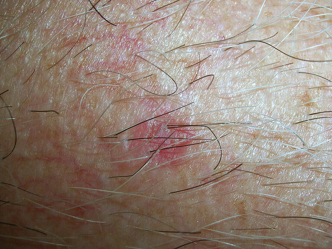 Basal cell carcinoma