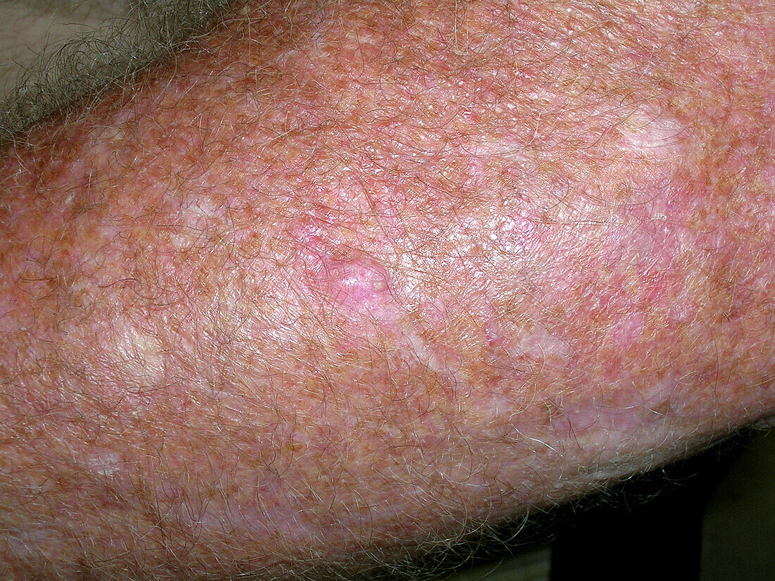 Basal cell carcinoma