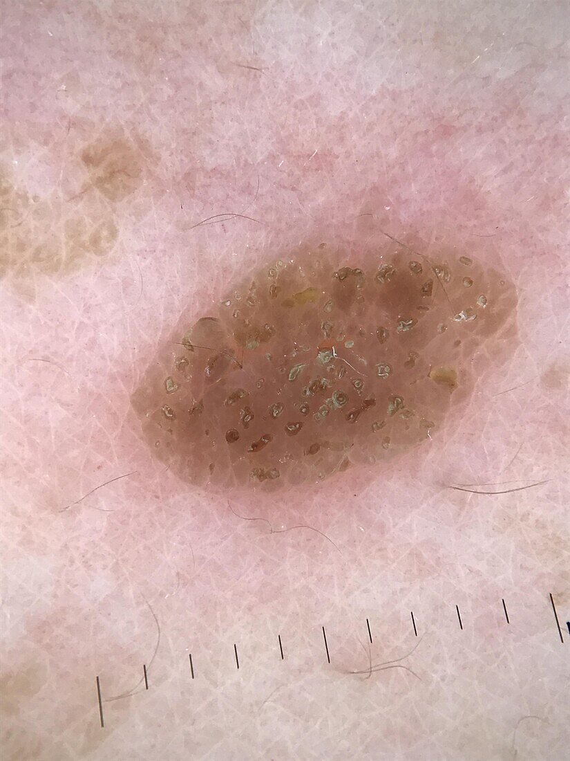 Seborrheic keratosis, dermoscopy