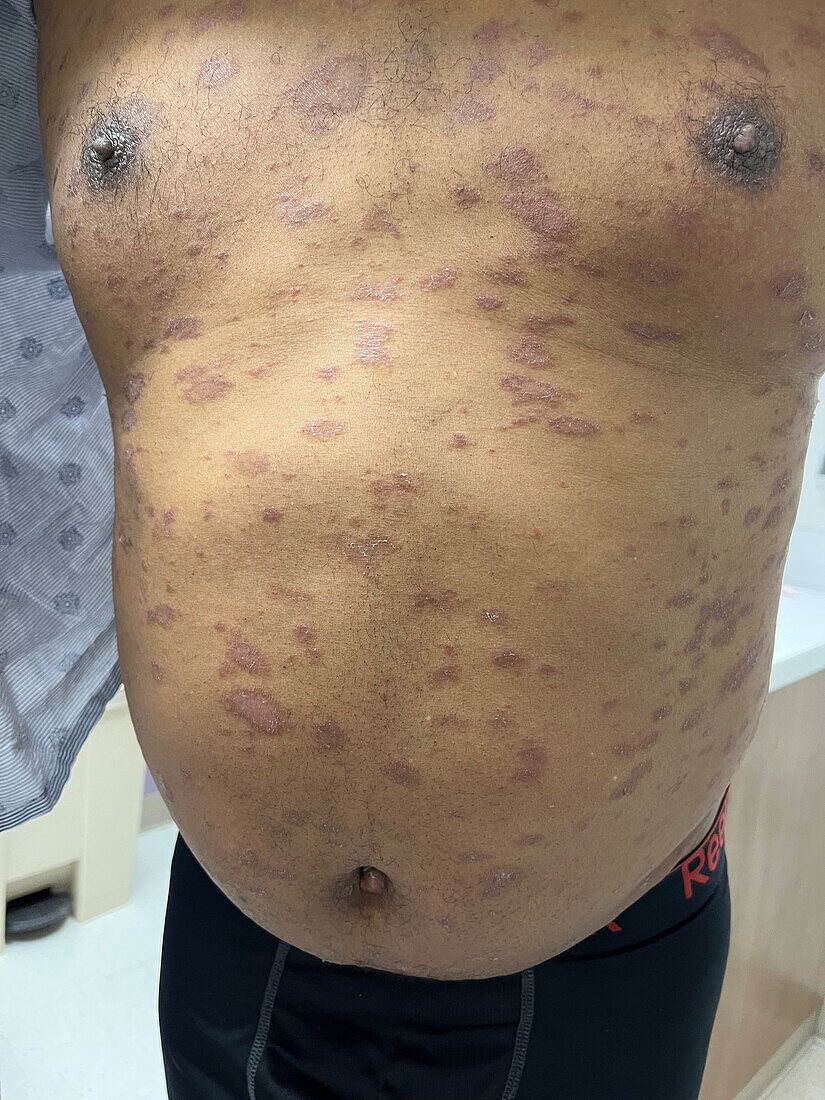 Plaque psoriasis on a man's trunk