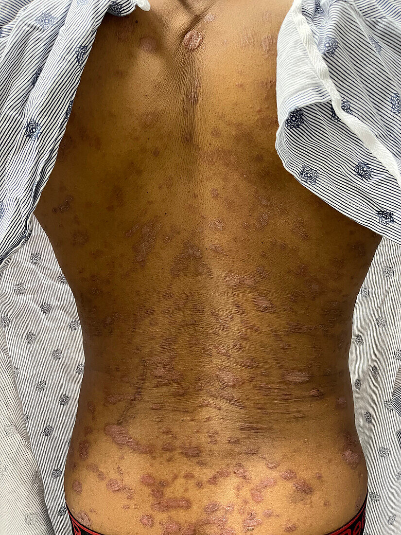 Plaque psoriasis on a man's back