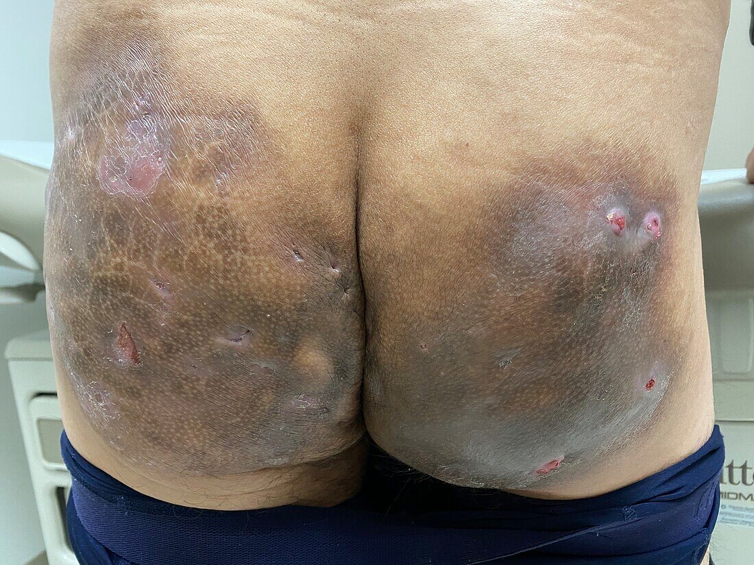 Hidradenitis suppurativa