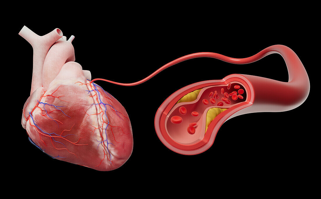 Coronary artery disease, illustration