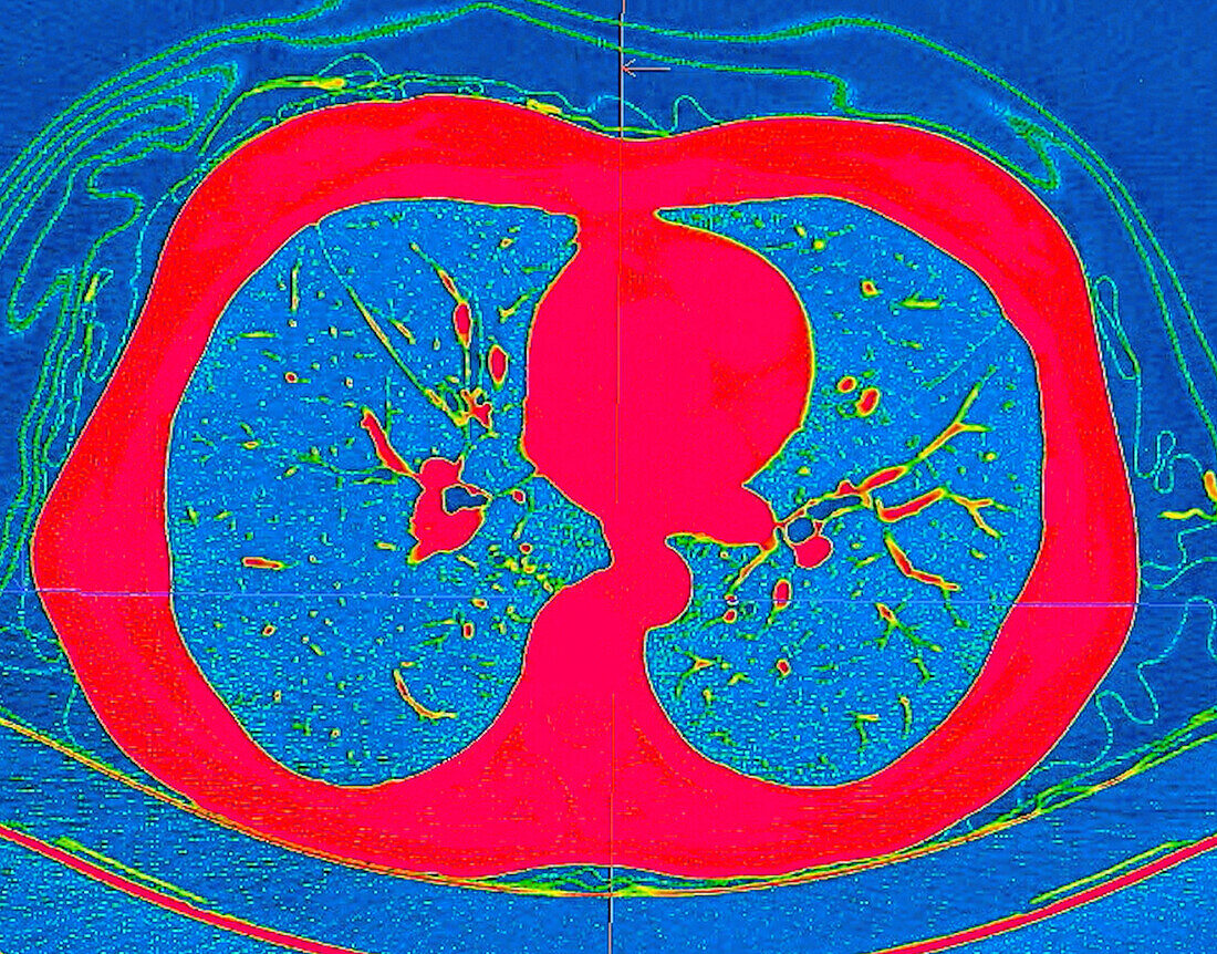 Healthy lungs, CT scan