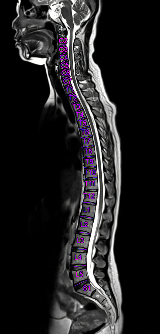 Healthy spinal column, myelogram