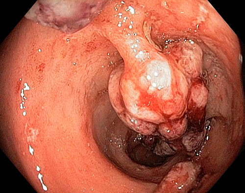 31+ Morbus crohn hautausschlag bilder , Morbus Crohn Bilder Science Photo Library