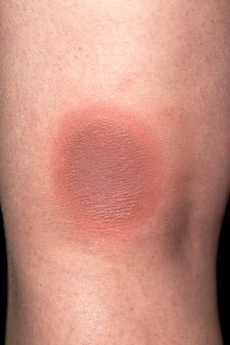 Erythema Multiforme Bilder Science Photo Library