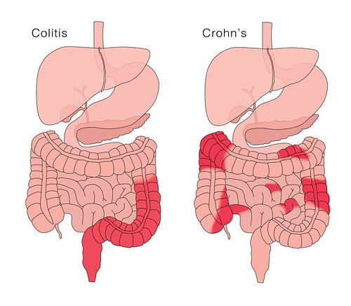 Morbus Crohn Bilder Science Photo Library