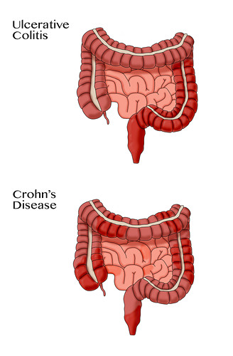 Morbus Crohn Bilder Science Photo Library