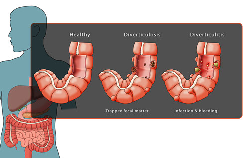 Divertikulose Bilder Science Photo Library