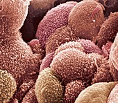 Ovarian cancer cells,SEM
