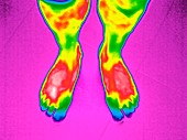 Feet,thermogram