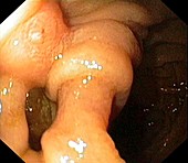 Diverticulum of the small intestine
