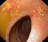 Ulcerative colitis of the colon