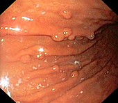 Stomach polyps