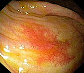 Angiodysplasia of the caecum
