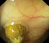Diverticular disease of the colon