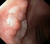 Benign polyp in the duodenal bulb