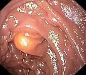 Lipoma of the duodenum