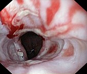 Oesophagitis