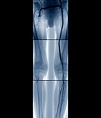 Artery bypass surgery,angiogram