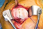 Shoulder joint re-surfacing surgery
