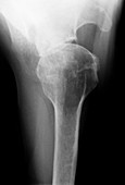 Osteoarthritis of the shoulder,X-ray