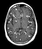 Diseased brain,MRI scan