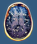 Diseased brain,MRI scan