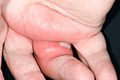 Cellulitis of the hand