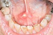 Salivary gland calculus