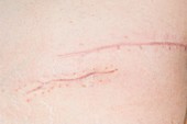 Abdominal scars