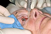 Cataract surgery