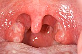 Inflamed tonsils