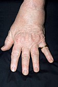 Psoriatic arthritis