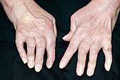 Rheumatoid arthritis