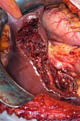 Gall bladder cancer surgery