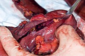 Pancreatic cancer,Whipple surgery