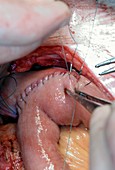 Pancreatic cancer,Whipple surgery