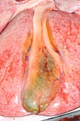 Gall bladder,post-mortem